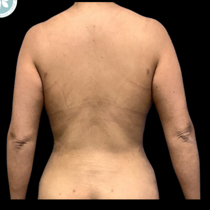 Liposuction Before & After Patient #4963