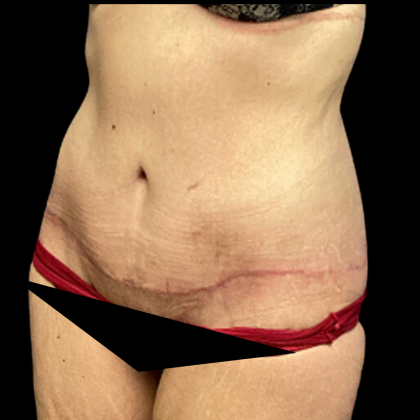 Tummy Tuck Before & After Patient #4965
