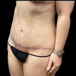 Tummy Tuck Before & After Patient #4967