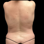 Tummy Tuck Before & After Patient #4968