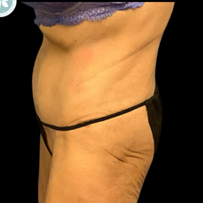 Tummy Tuck Before & After Patient #4970