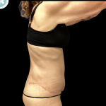 Tummy Tuck Before & After Patient #4971