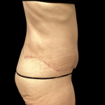 Tummy Tuck Before & After Patient #4972