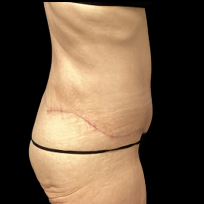 Tummy Tuck Before & After Patient #4972
