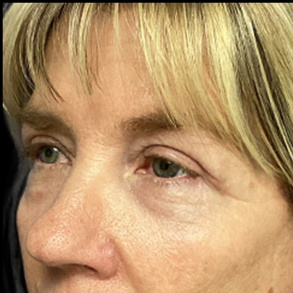 Blepharoplasty Before & After Patient #5080