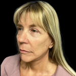 Facelift Before & After Patient #5081