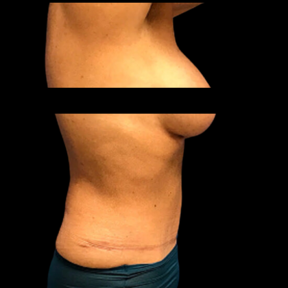 Mommy Makeover Before & After Patient #5082