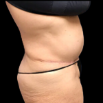 Tummy Tuck Before & After Patient #5084