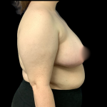 Breast Reduction Before & After Patient #5085
