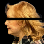 Facelift Before & After Patient #5086