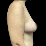 Breast Reduction Before & After Patient #4904