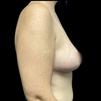 Breast Reduction Before & After Patient #4904