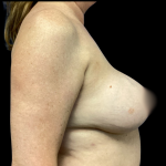 Implant Removal Before & After Patient #4906