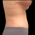 Mommy Makeover Before & After Patient #4907