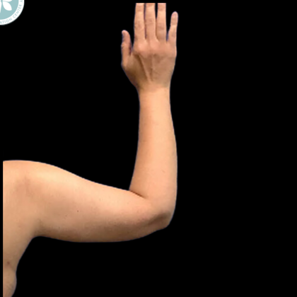Arm Lift Before & After Patient #4946