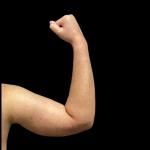 Arm Lift Before & After Patient #4947