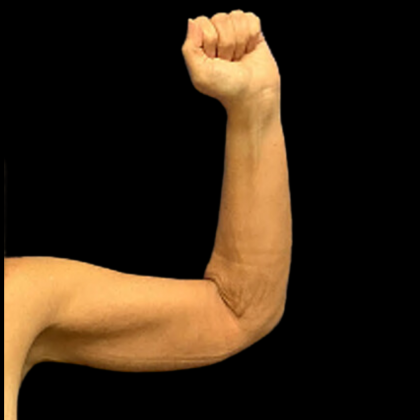 Arm Lift Before & After Patient #4948