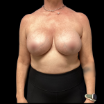 Implant Removal Before & After Patient #5253