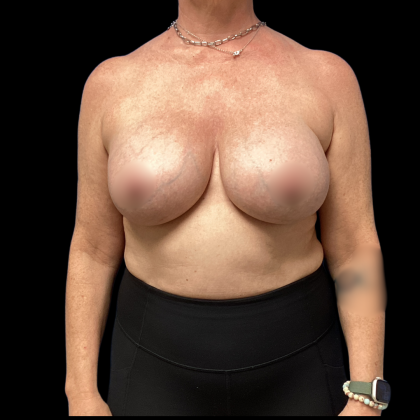 Implant Removal Before & After Patient #5253