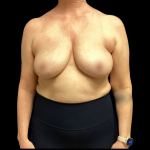 Implant Removal Before & After Patient #5253