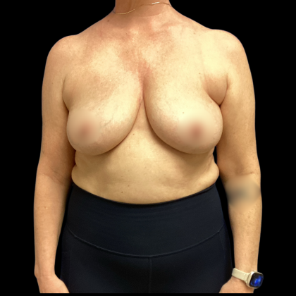 Implant Removal Before & After Patient #5253