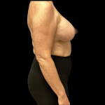 Implant Removal Before & After Patient #5253