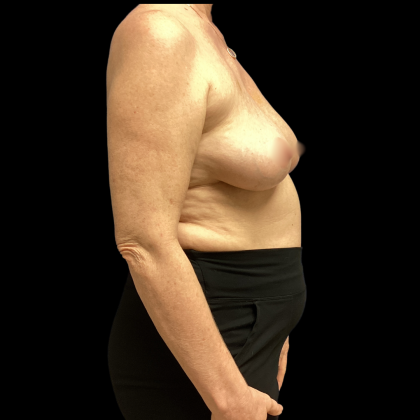 Implant Removal Before & After Patient #5253