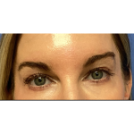 Blepharoplasty Before & After Patient #5243