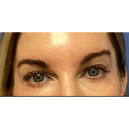Blepharoplasty Before & After Patient #5243
