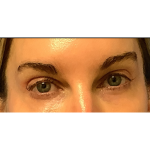 Blepharoplasty Before & After Patient #5243