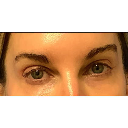 Blepharoplasty Before & After Patient #5243