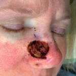 MOHS Before & After Patient #5420