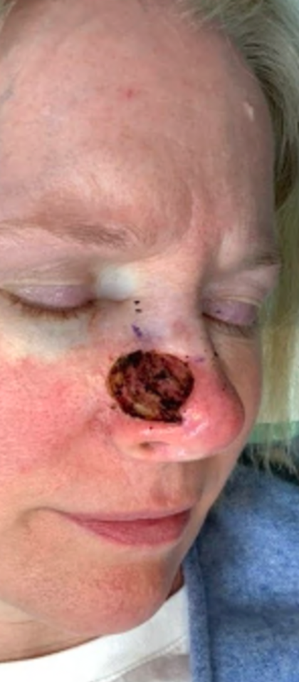 MOHS Before & After Patient #5420