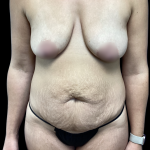 Mommy Makeover Before & After Patient #5295