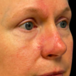 MOHS Before & After Patient #5420