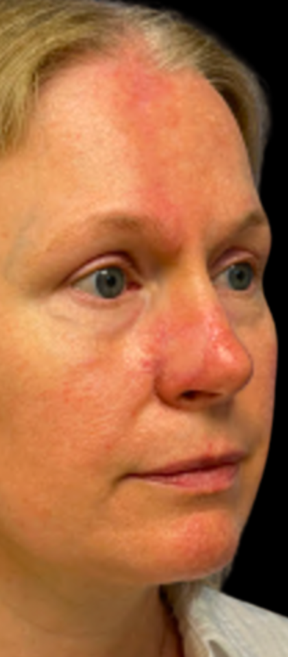 MOHS Before & After Patient #5420