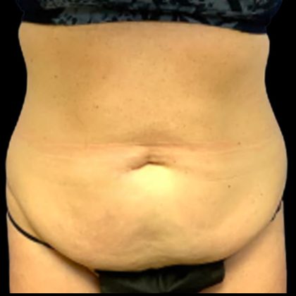 Tummy Tuck Before & After Patient #5433