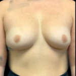 Breast Augmentation Before & After Patient #5342