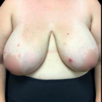 Breast Reduction Before & After Patient #5355