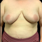 Breast Reduction Before & After Patient #5355
