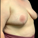 Breast Reduction Before & After Patient #5355