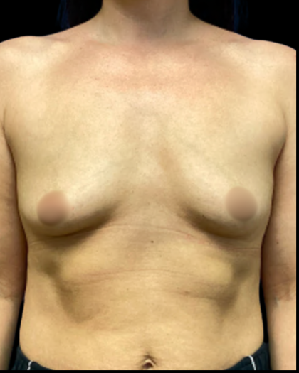 Breast Augmentation Before & After Patient #5341