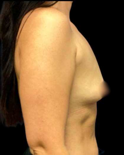 Breast Augmentation Before & After Patient #5341