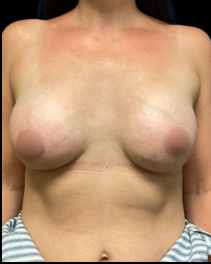 Breast Augmentation Before & After Patient #5341