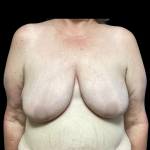Breast Reconstruction Before & After Patient #5343