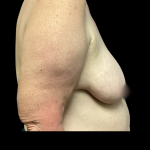 Breast Reconstruction Before & After Patient #5343