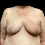 Breast Reconstruction Before & After Patient #5343
