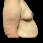 Breast Reconstruction Before & After Patient #5343