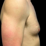 Gynecomastia Before & After Patient #5347