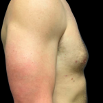 Gynecomastia Before & After Patient #5347